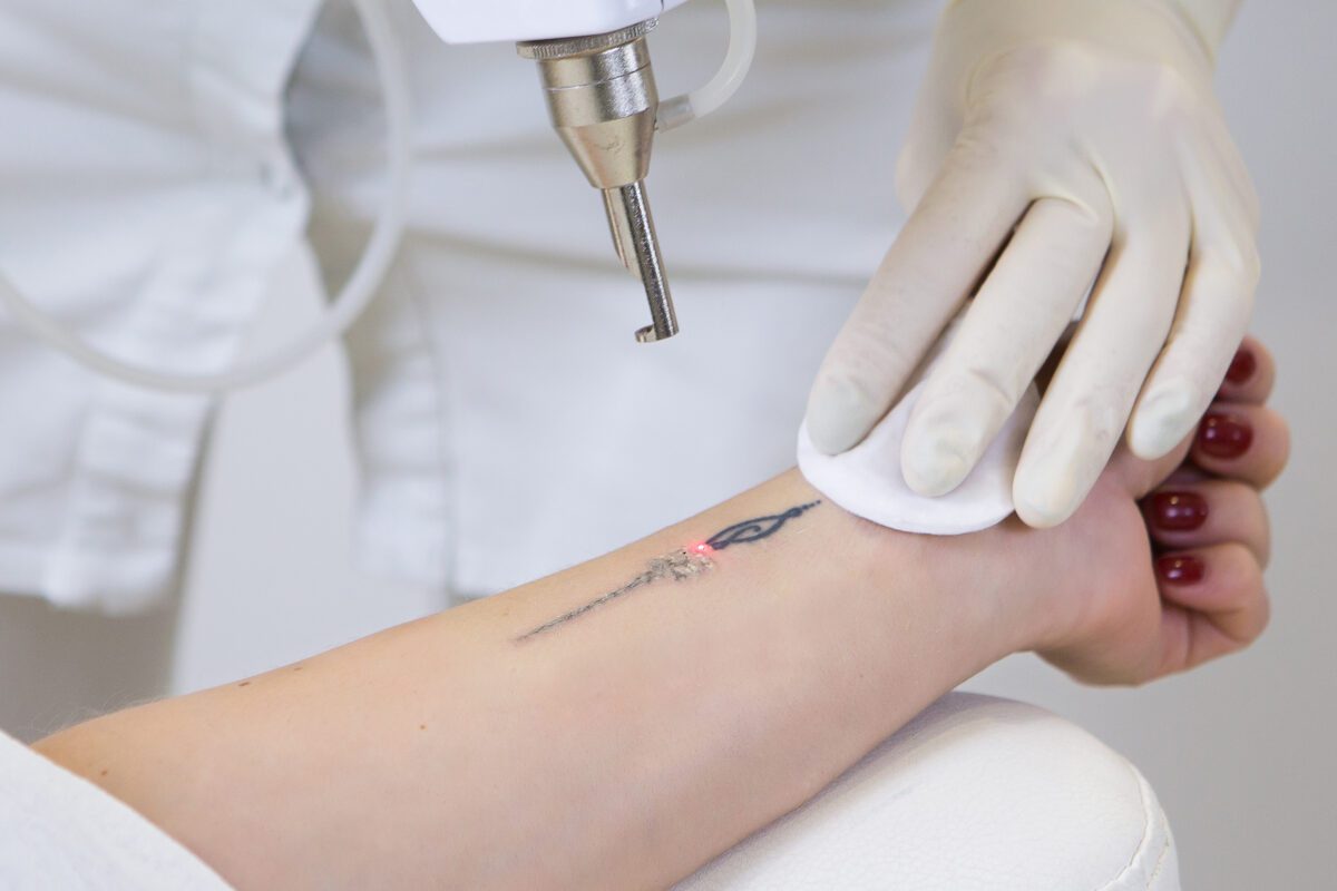 Laser Tattoo Removal Scotland, Edinburgh, Glasgow, Canterbury, Kirkcaldy, Edinburgh