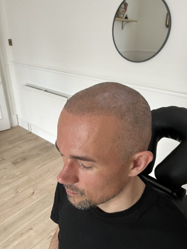 Before and after Scalp Micropigmentation Scotland, Glasgow, Edinburgh, Canterbury, Kent