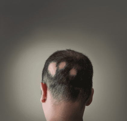alopecia on women