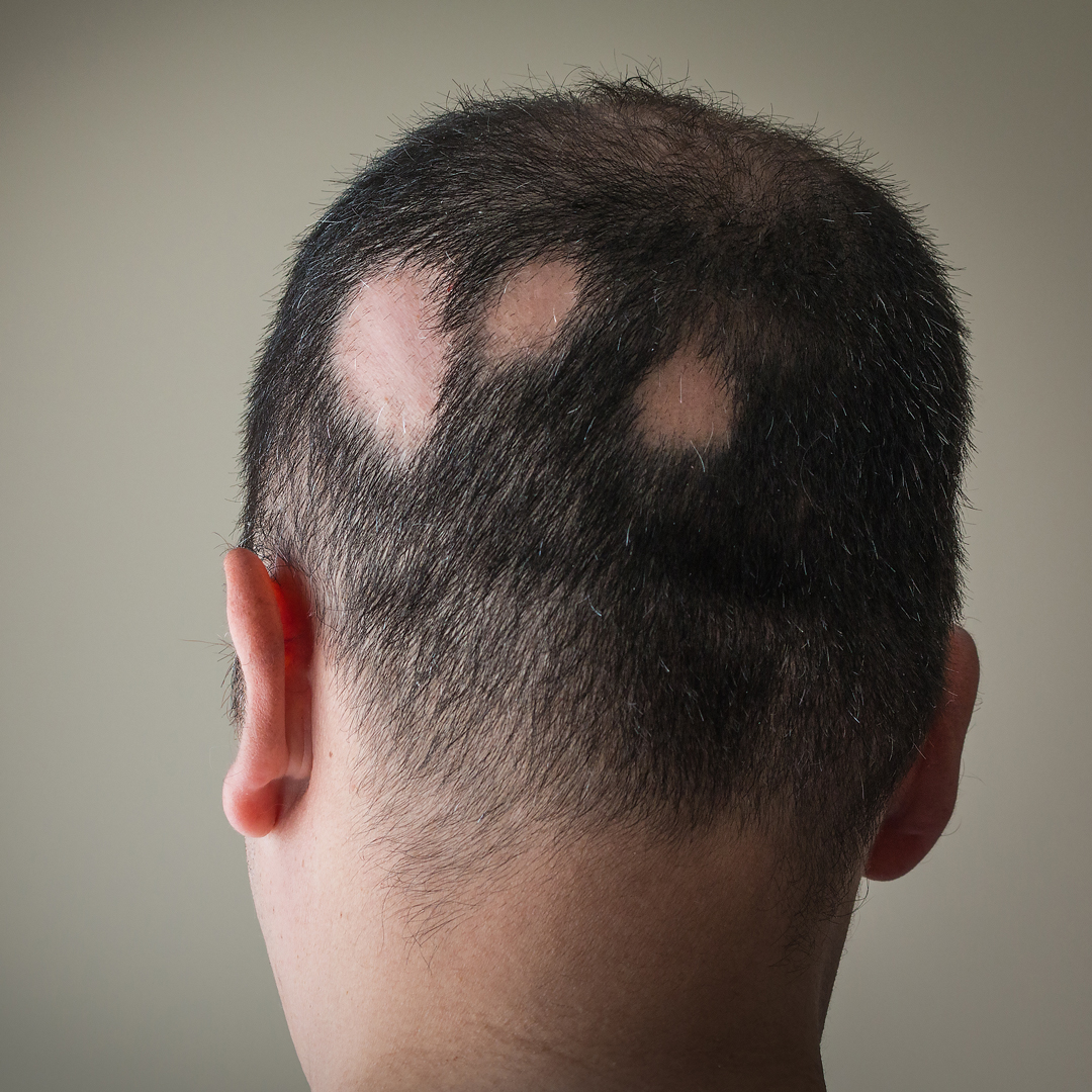 Scalp Micropigmentation for Alopecia, SMP Atelier, Canterbury Kent