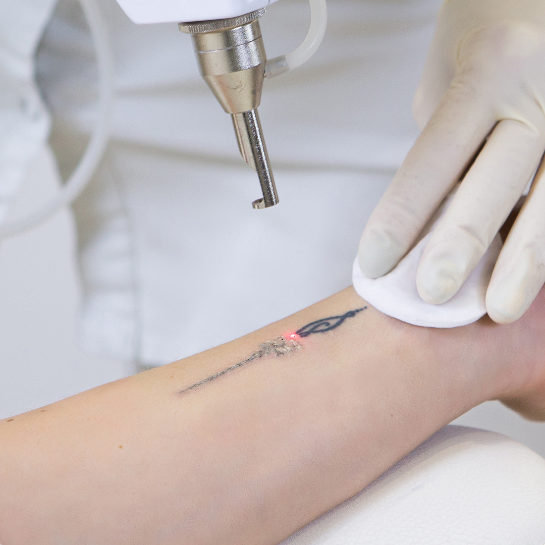 Laser tattoo removal in Canterbury Kent, SMP Atelier