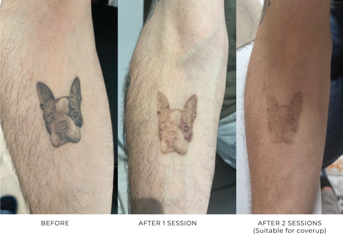 Laser tattoo removal before and after SMP Atelier, Canterbury