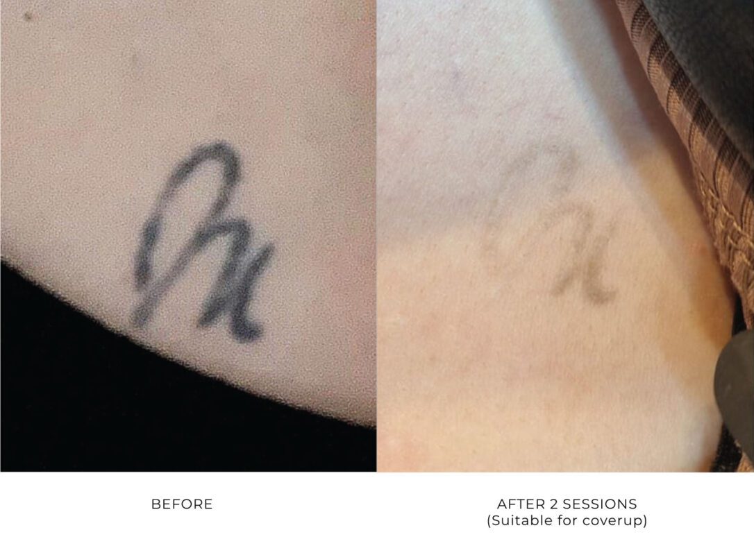 laser tattoo removal smp atelier