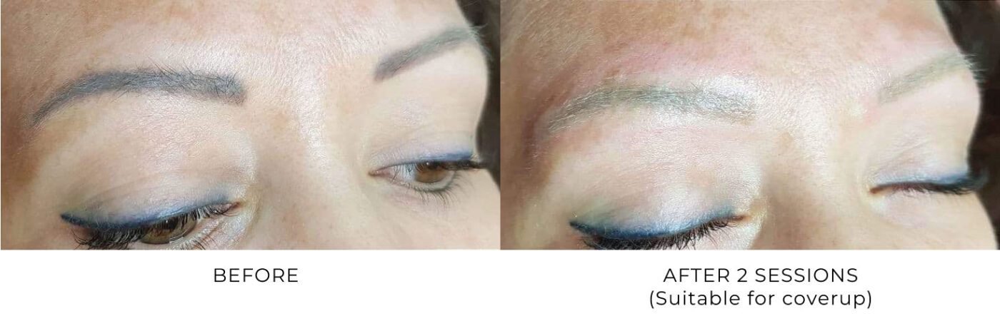 PMU Removal Before and After