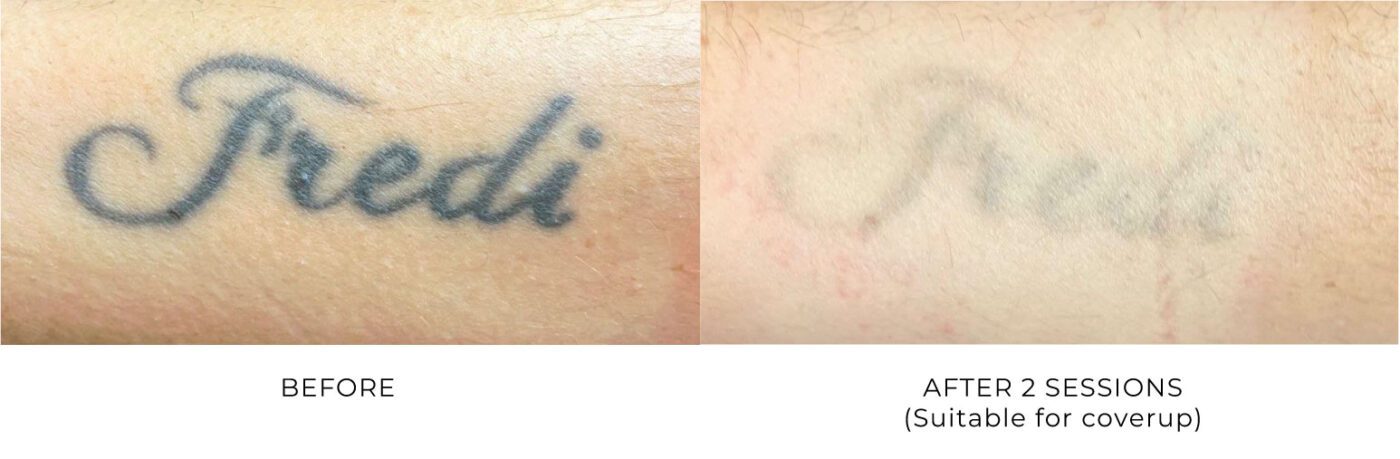 small tattoo removal before and after SMP Atelier